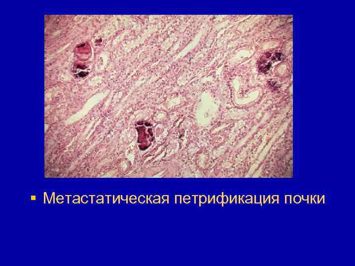 § Метастатическая петрификация почки 
