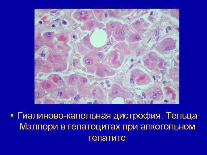 § Гиалиново-капельная дистрофия. Тельца Мэллори в гепатоцитах при алкогольном гепатите 