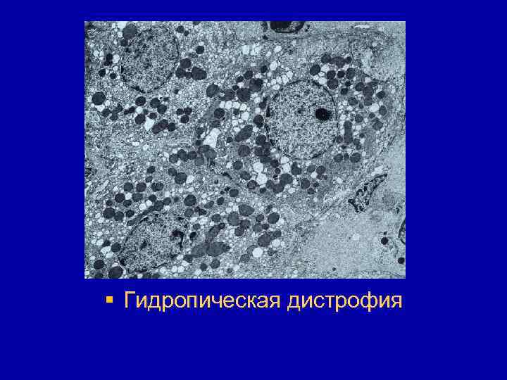 § Гидропическая дистрофия 