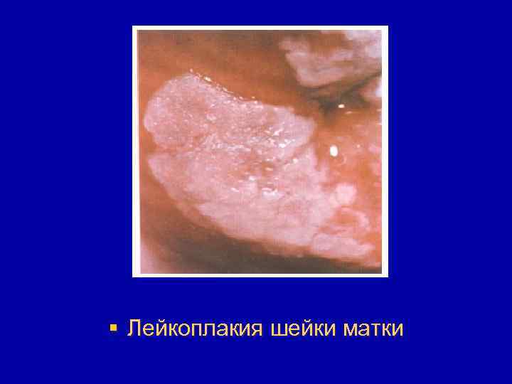 § Лейкоплакия шейки матки 