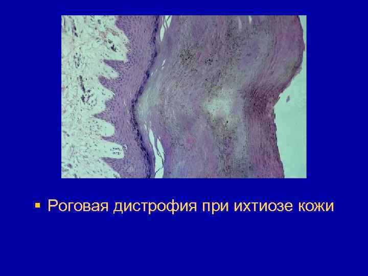 § Роговая дистрофия при ихтиозе кожи 