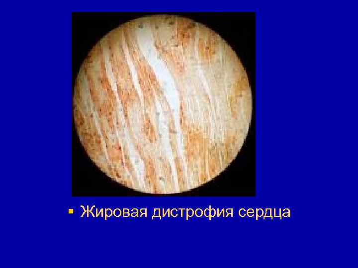 § Жировая дистрофия сердца 