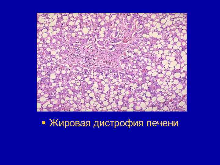 § Жировая дистрофия печени 