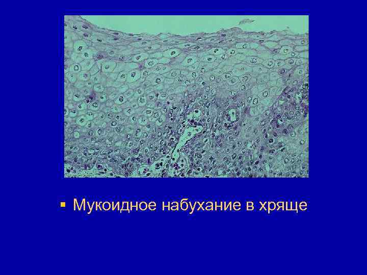 § Мукоидное набухание в хряще 