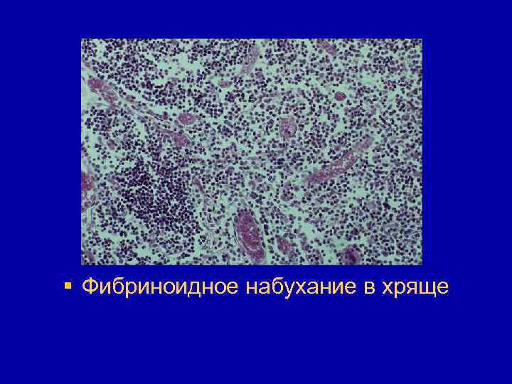 § Фибриноидное набухание в хряще 