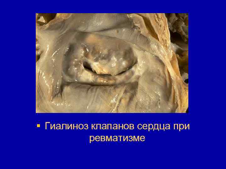 § Гиалиноз клапанов сердца при ревматизме 