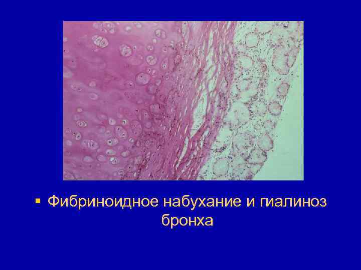 § Фибриноидное набухание и гиалиноз бронха 