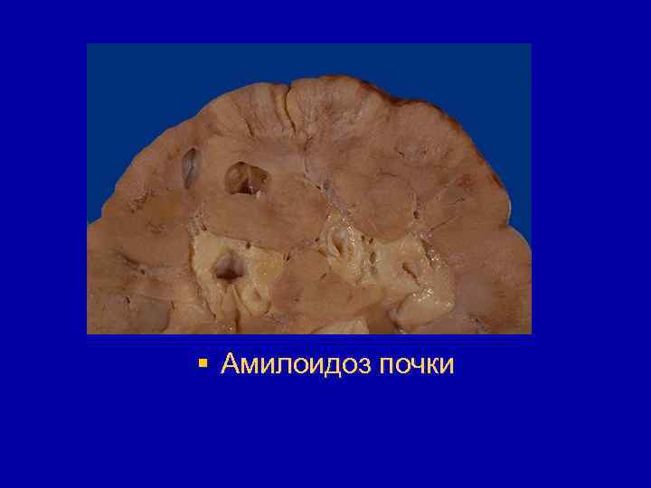 § Амилоидоз почки 