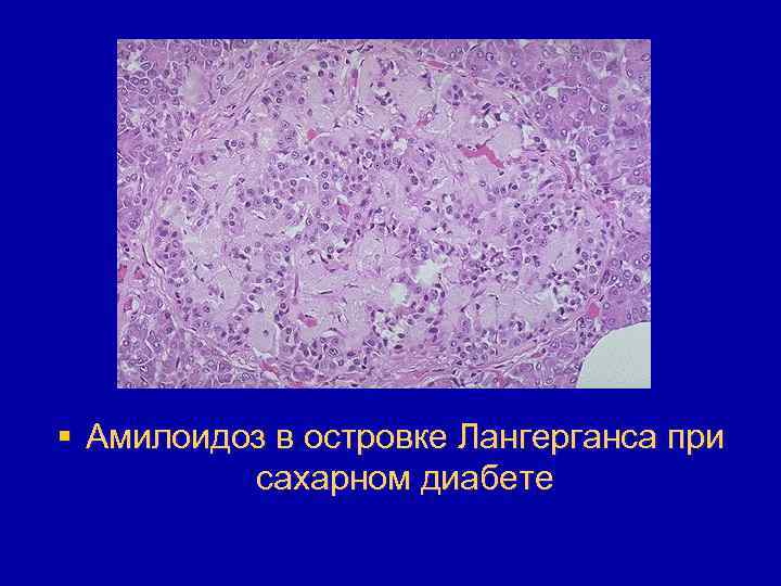 § Амилоидоз в островке Лангерганса при сахарном диабете 