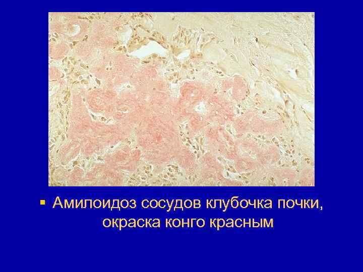 § Амилоидоз сосудов клубочка почки, окраска конго красным 
