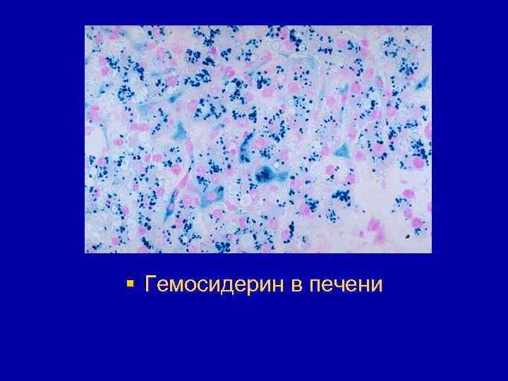 § Гемосидерин в печени 