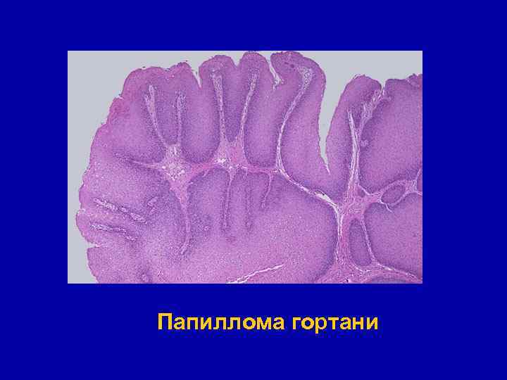 Папиллома гортани 