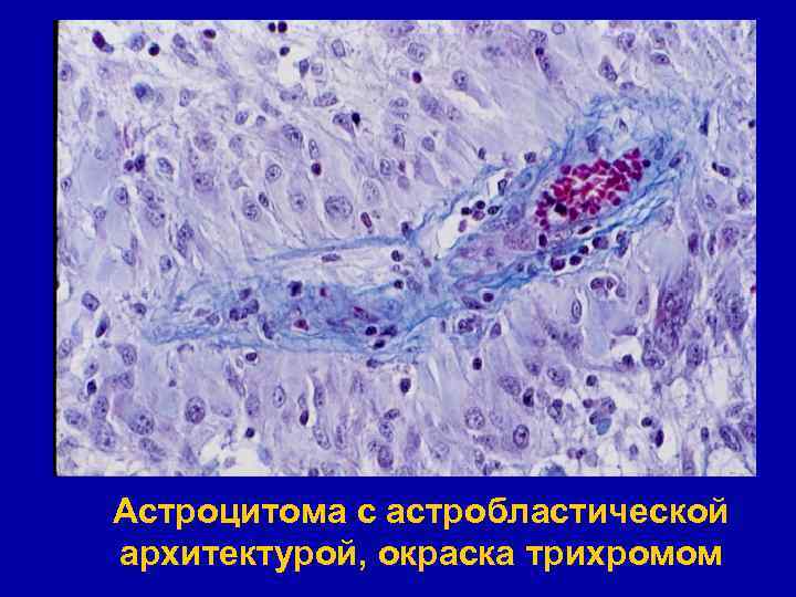 Астроцитома с астробластической архитектурой, окраска трихромом 
