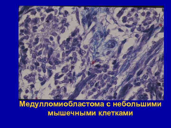 Медулломиобластома с небольшими мышечными клетками 