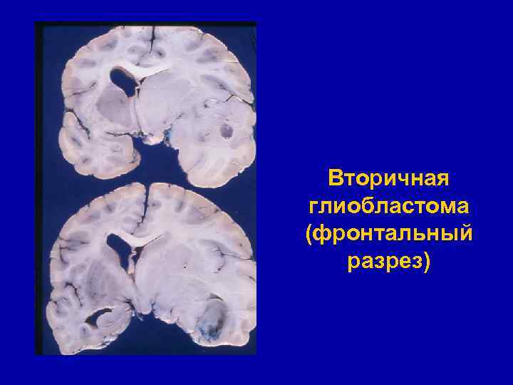 Вторичная глиобластома (фронтальный разрез) 