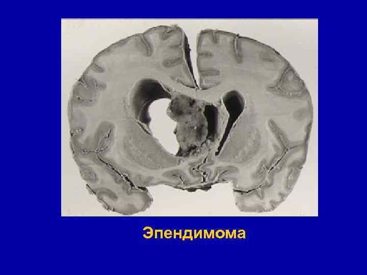 Эпендимома 