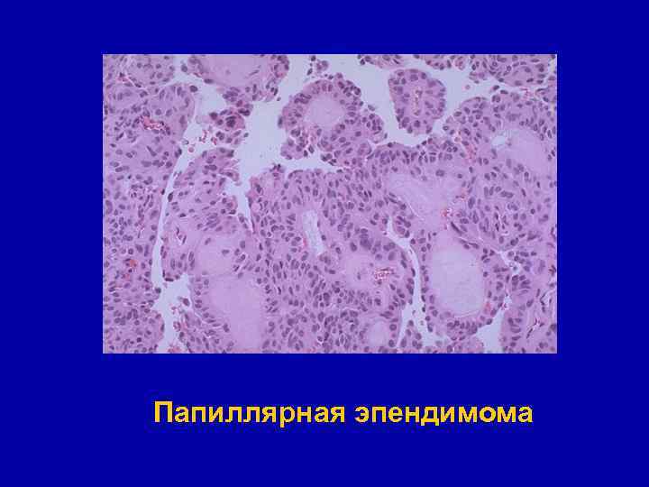 Папиллярная эпендимома 