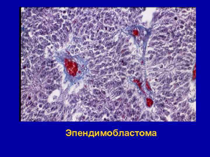 Эпендимобластома 