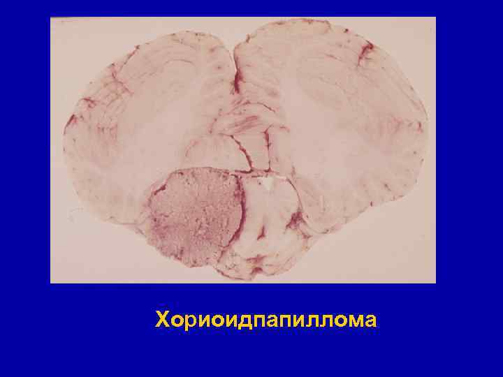 Хориоидпапиллома 