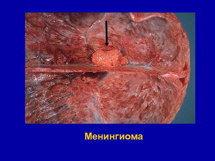 Менингиома 
