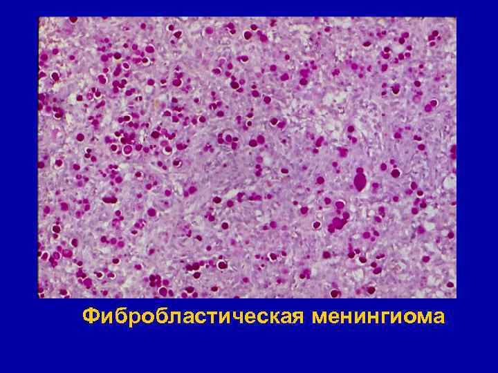 Фибробластическая менингиома 