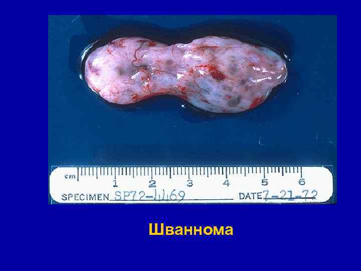 Шваннома 