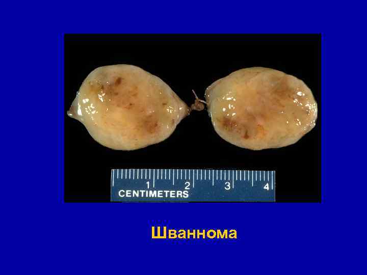 Шваннома 