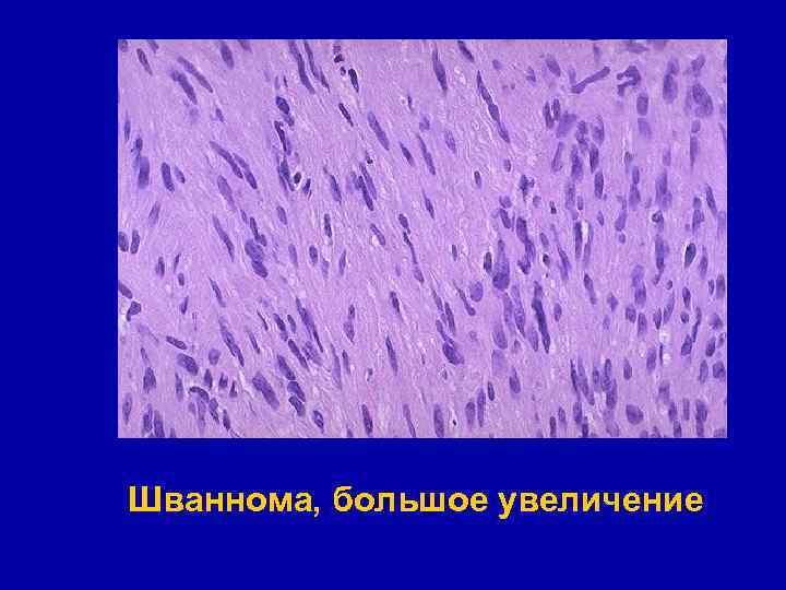 Шваннома, большое увеличение 