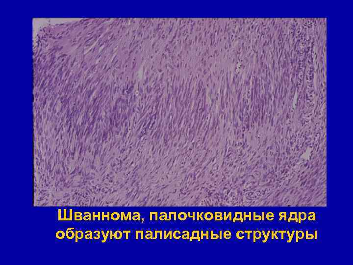 Шваннома, палочковидные ядра образуют палисадные структуры 