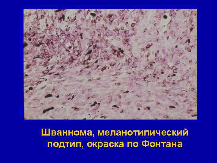 Шваннома, меланотипический подтип, окраска по Фонтана 