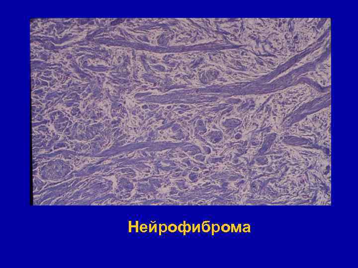 Нейрофиброма 