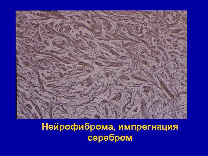Нейрофиброма, импрегнация серебром 