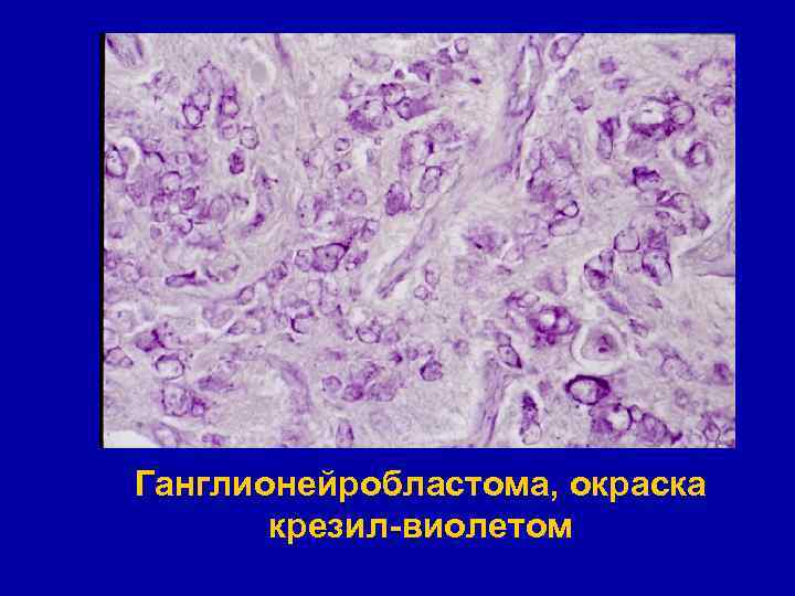 Ганглионейробластома, окраска крезил-виолетом 