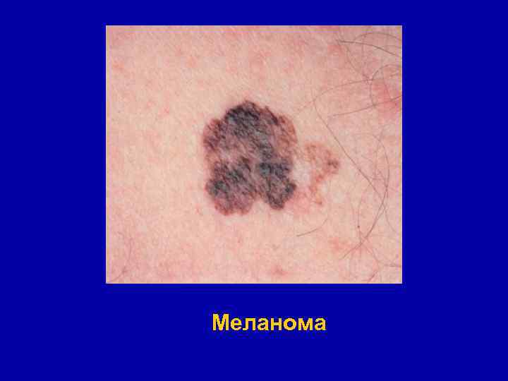 Меланома 