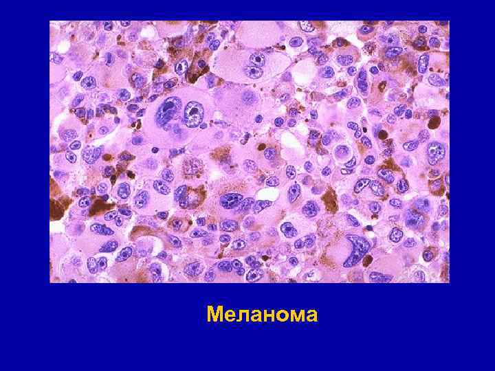 Меланома 