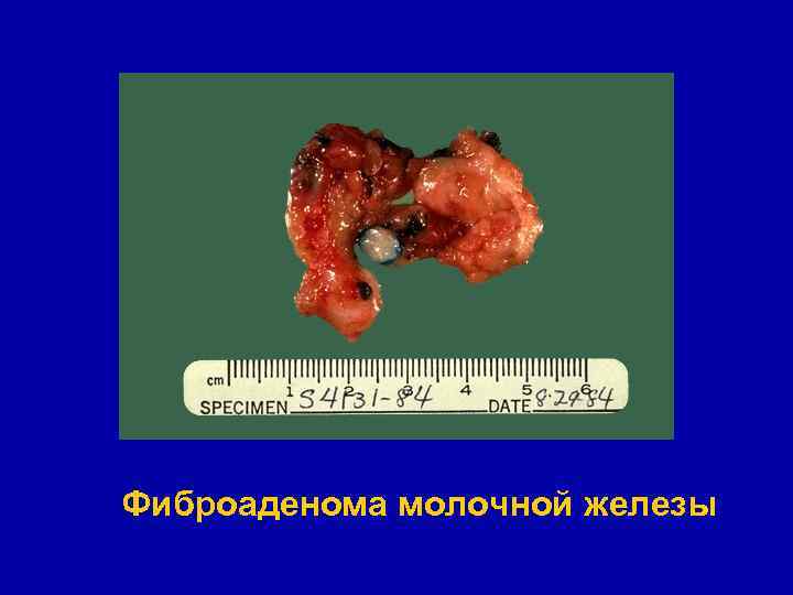 Фиброаденома молочной железы 