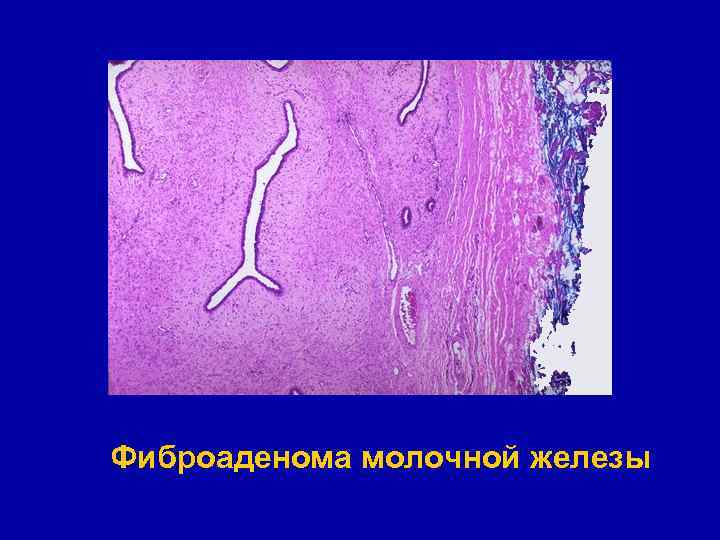 Фиброаденома молочной железы 