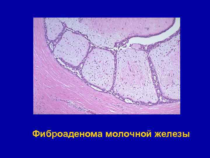 Фиброаденома молочной железы 