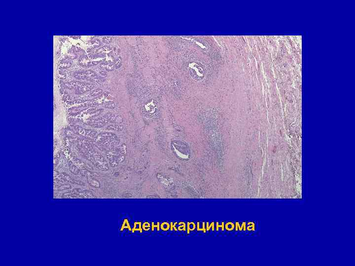 Аденокарцинома 