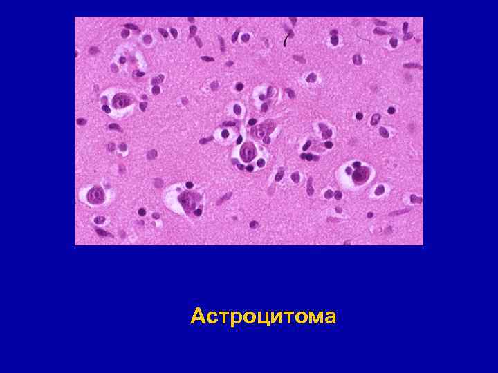 Астроцитома 