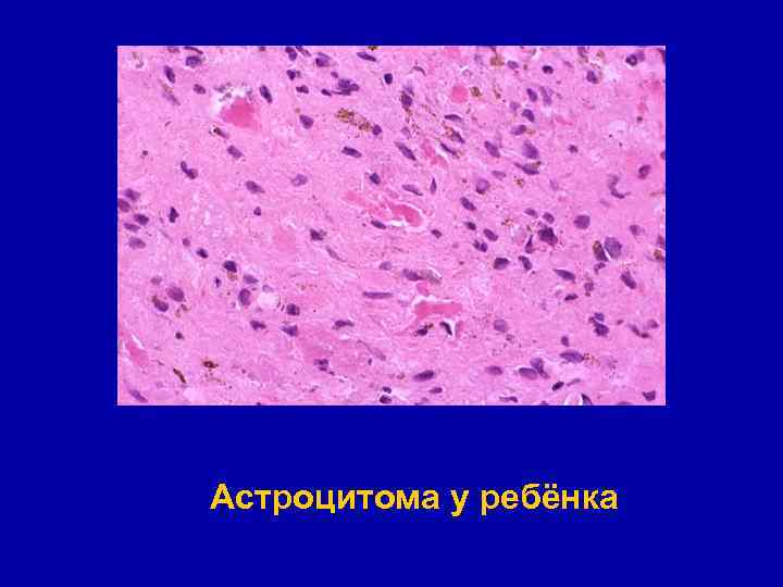 Астроцитома у ребёнка 
