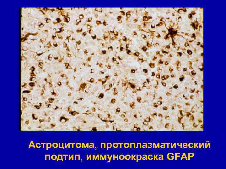 Астроцитома, протоплазматический подтип, иммуноокраска GFAP 