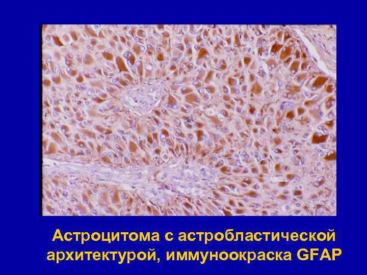 Астроцитома с астробластической архитектурой, иммуноокраска GFAP 