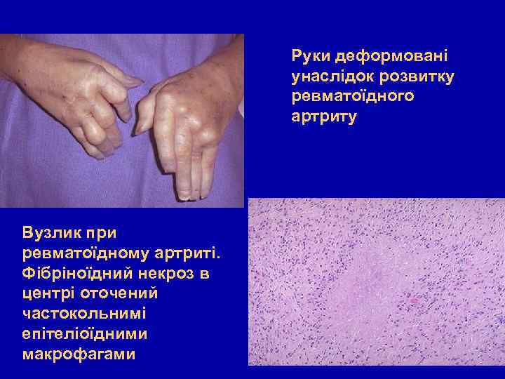 Руки деформовані унаслідок розвитку ревматоїдного артриту Вузлик при ревматоїдному артриті. Фібріноїдний некроз в центрі