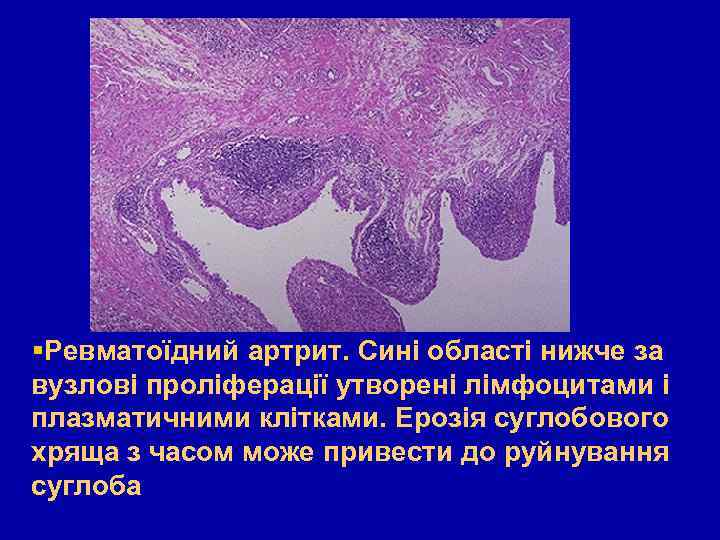  Ревматоїдний артрит. Сині області нижче за вузлові проліферації утворені лімфоцитами і плазматичними клітками.