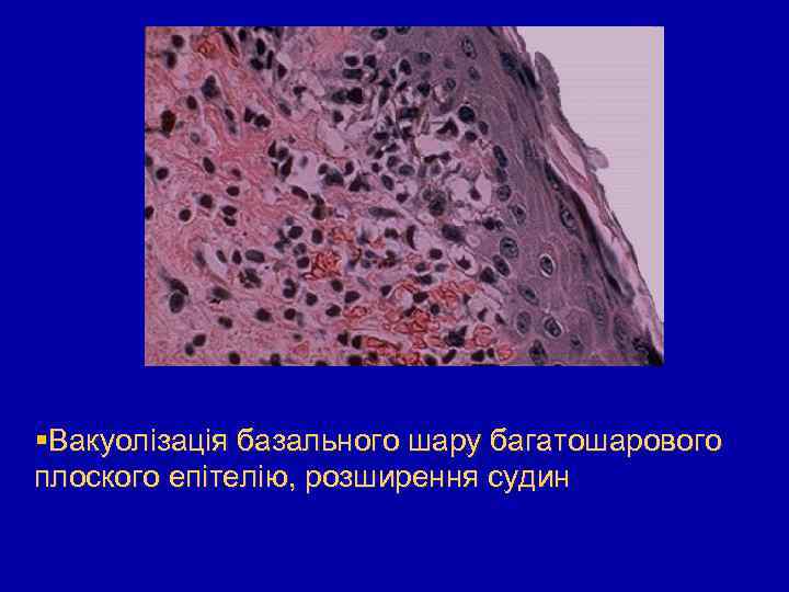  Вакуолізація базального шару багатошарового плоского епітелію, розширення судин 