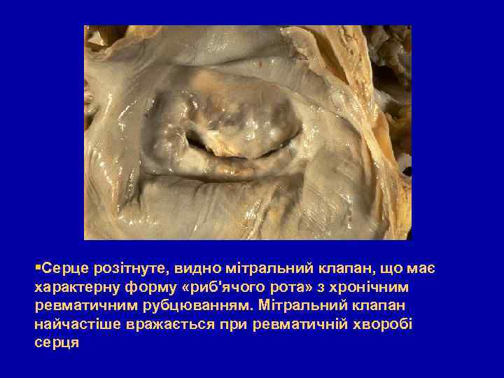  Серце розітнуте, видно мітральний клапан, що має характерну форму «риб'ячого рота» з хронічним