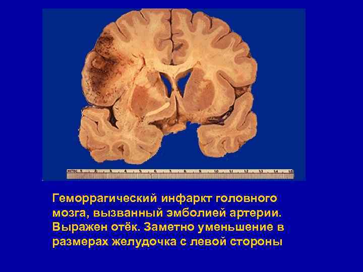 Инфаркт мозга это. Ишемический инсульт мозга макропрепарат. Инфаркт головного мозга макропрепарат. Ишемический инфаркт головного мозга макропрепарат. Инфаркт головного мозга макропрепарат описание.