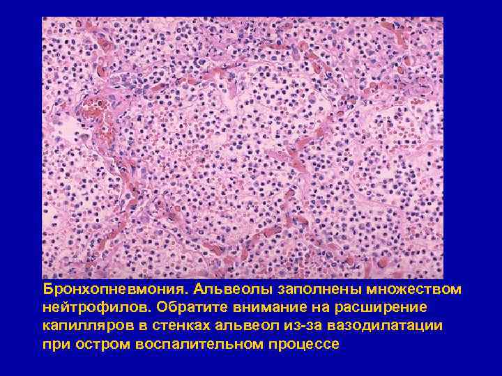 Бронхопневмония. Альвеолы заполнены множеством нейтрофилов. Обратите внимание на расширение капилляров в стенках альвеол из-за