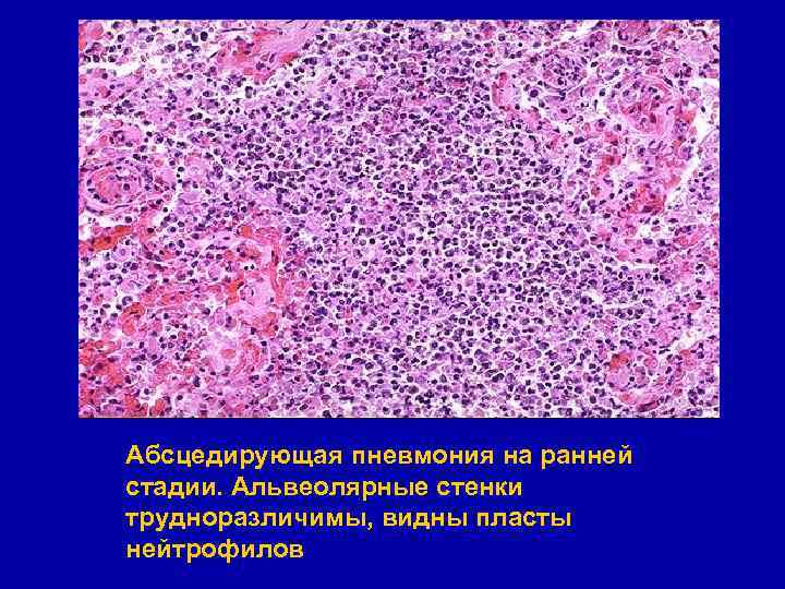 Абсцедирующая пневмония на ранней стадии. Альвеолярные стенки трудноразличимы, видны пласты нейтрофилов 